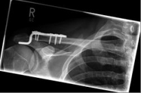 Schlüsselbein 3 Schlüsselbein 3