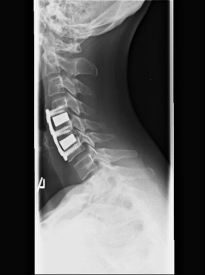 Spinalkanalstenose III Spinalkanalstenose III