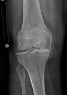 Ro_Bilder_praeop_1_3 Röntgenbild vor OP von vorn